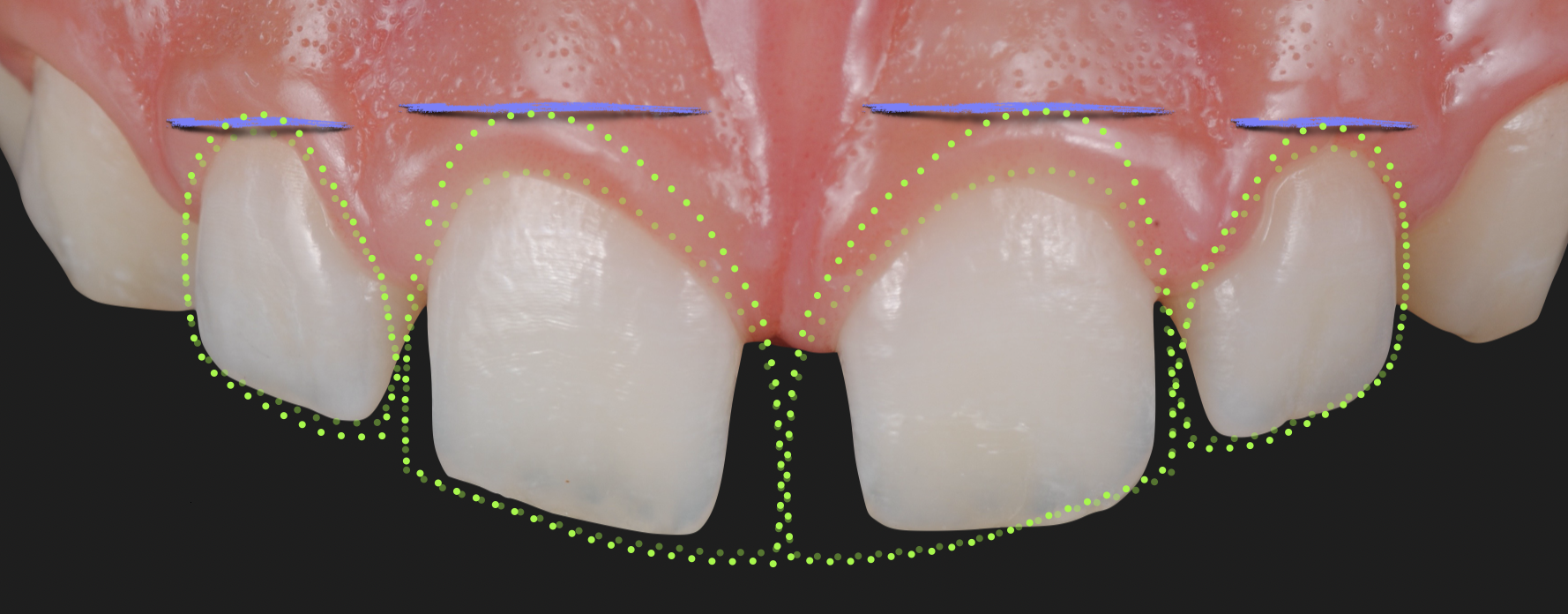 Managing every color and shape in aesthetic composite restorations