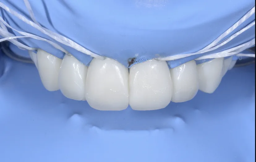 Faccette in composito: tecnica, indicazioni cliniche e vantaggi