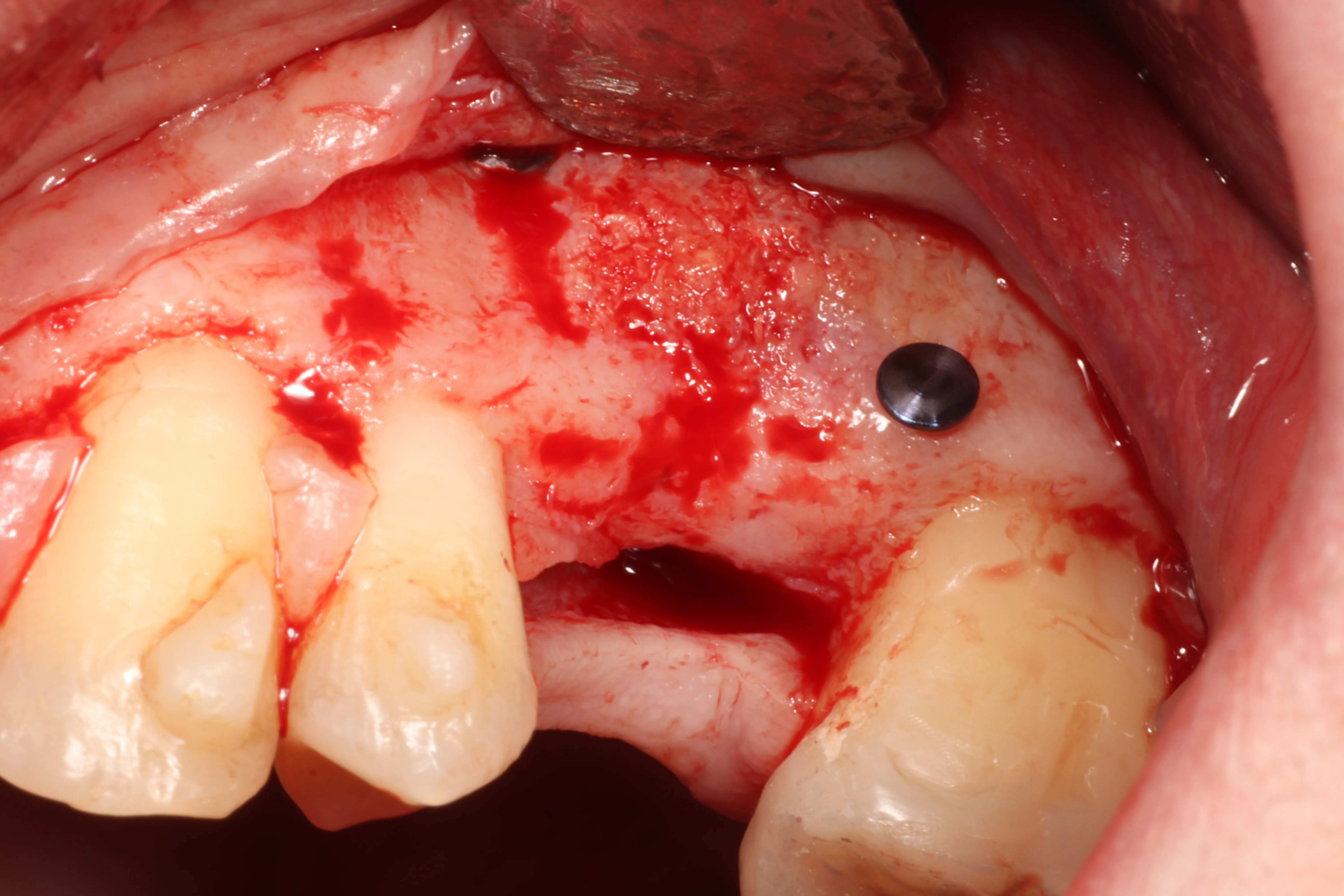 REASONED APPROACH TO POSTERIOR MAXILLARY ATROPHIES